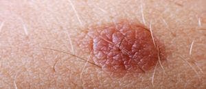 Study Finds Melanoma Rates Drop Sharply Among Teens and Young Adults