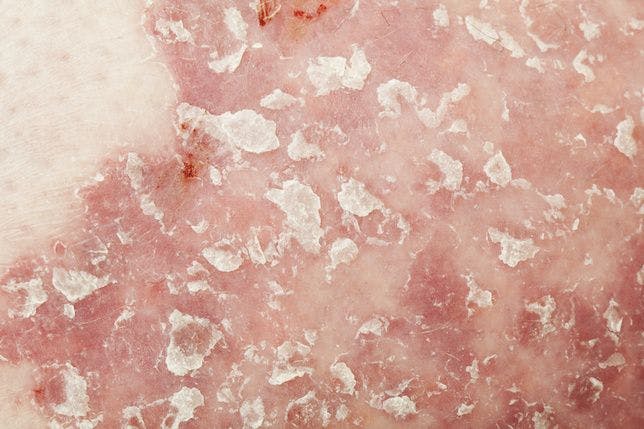 FDA Expands Topical Treatment Options for Adolescents with Plaque Psoriasis